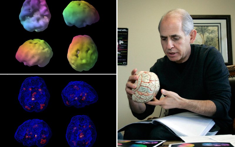 New Medical Research by Amen Clinics Advances Treatment Options for